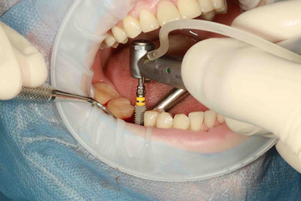 Person getting a dental implant installed