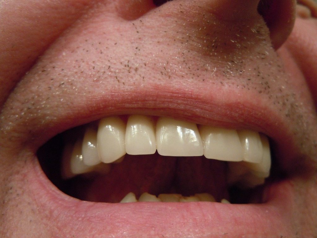 Man with dental crowns